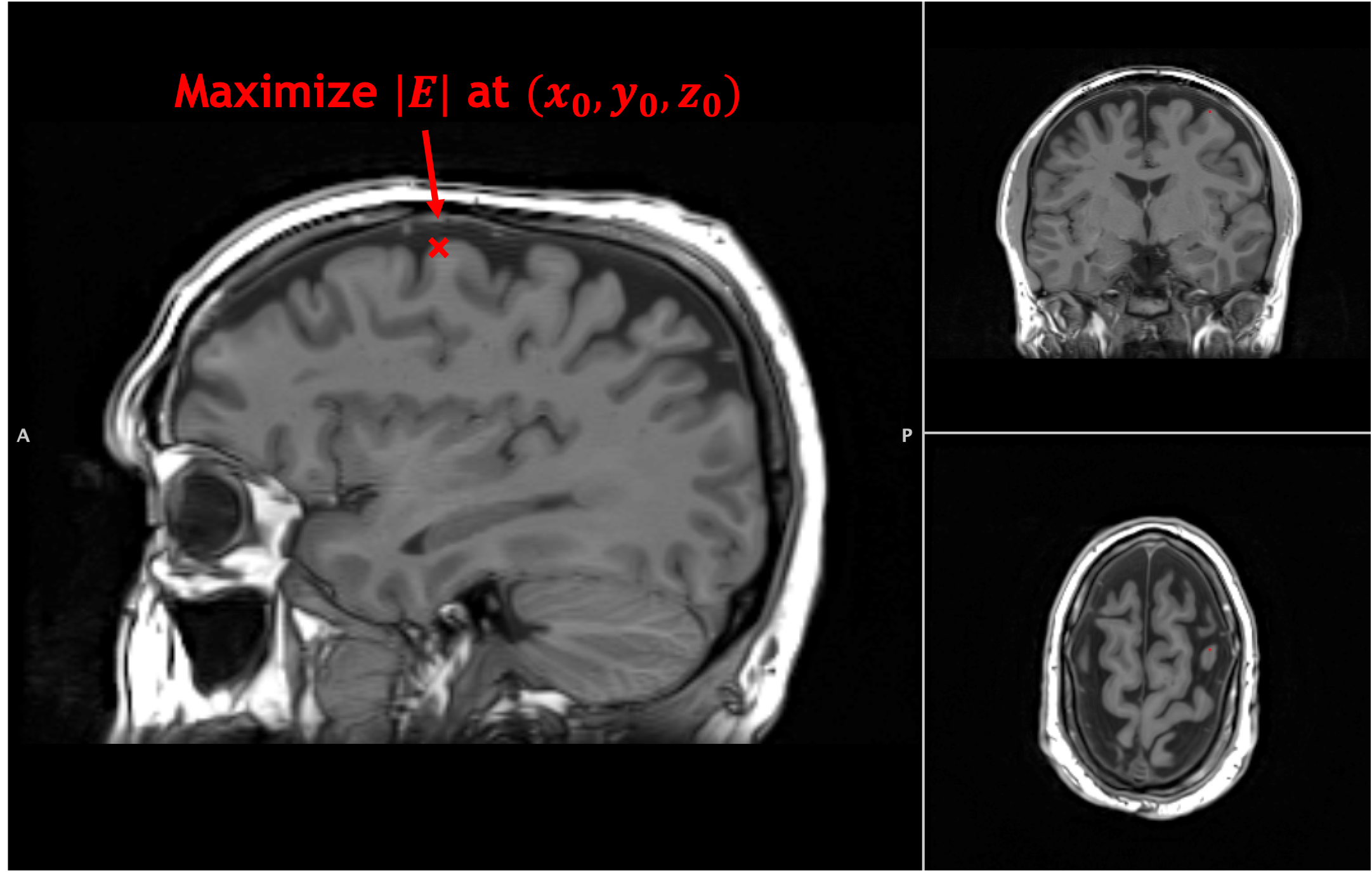 Target region is selected from patient's MRI.