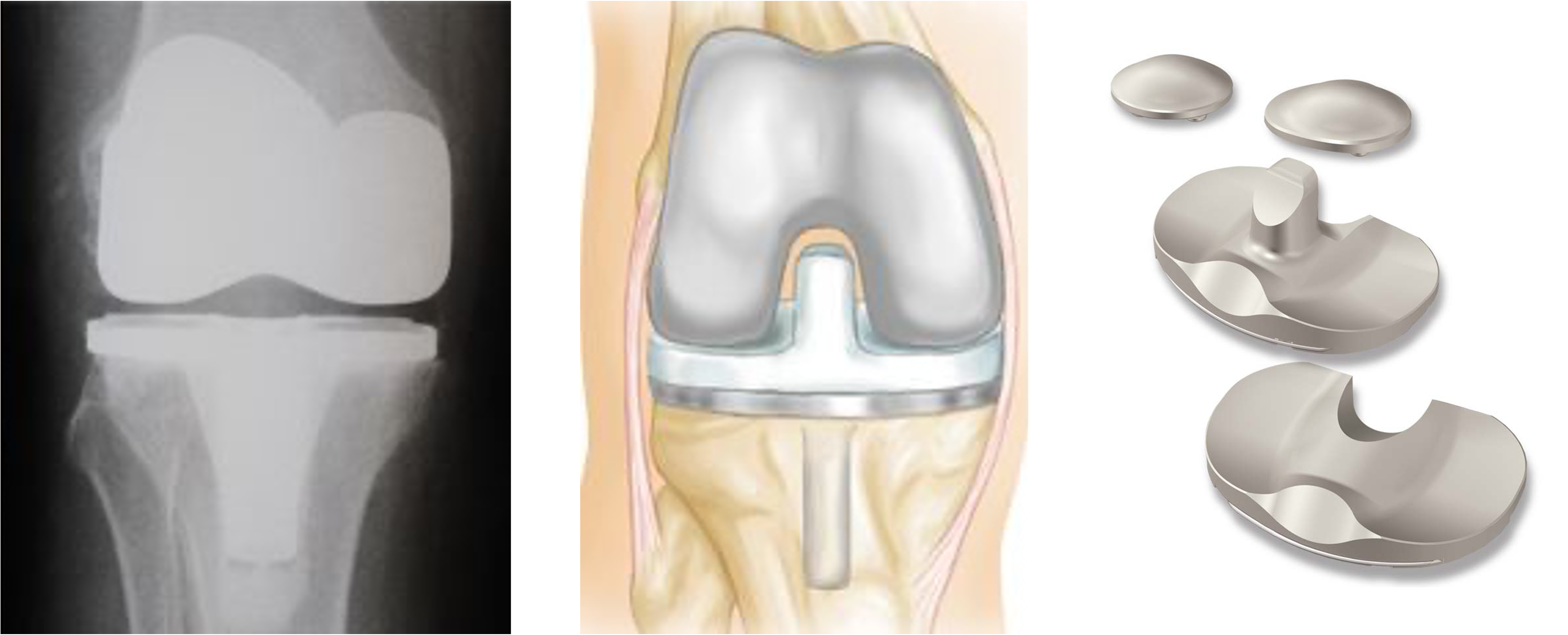 Total Knee Replacement